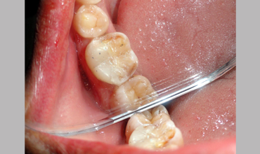 Root canal treatment in Anand
                        